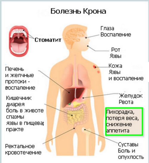 болезнь Крона