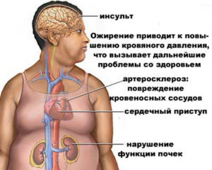 Расплата за ожирение неизбежна